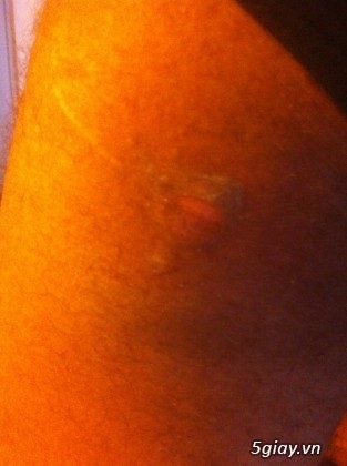 OnePlus One phát nổ trong túi làm bị thương một người - 31292