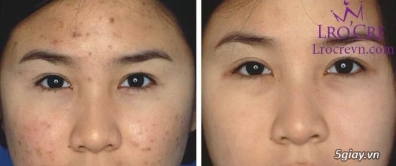 Mỹ Phẩm Trắng Da,Trị Mụn,Thâm, Nám..Hàng Cao Cấp,Chính Hãng,CAM KẾT BẢO HÀNH SẢN PHẨM - 27