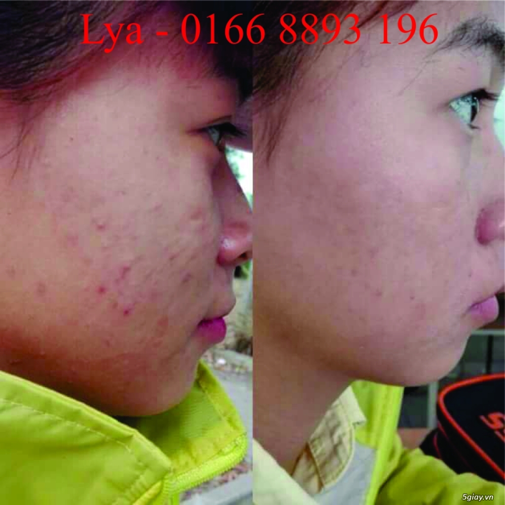 Lya Shop - Thuốc Bắc Trị Mụn HIỆU QUẢ, AN TOÀN nguồn gốc THIÊN NHIÊN - 9