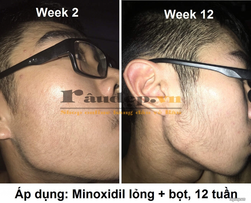 Thuốc Mọc Râu Quai Nón Minoxidil 5% của Mỹ >>|Chắc Chắn Mọc Râu| - 10