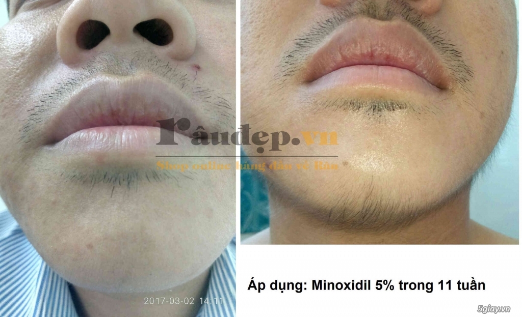 Thuốc Mọc Râu Quai Nón Minoxidil 5% của Mỹ >>|Chắc Chắn Mọc Râu| - 7