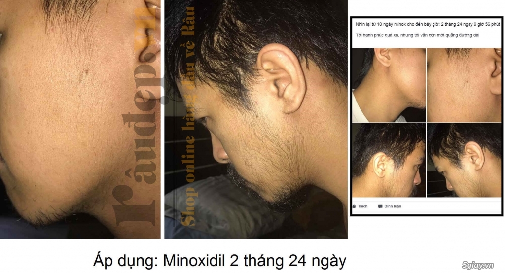 Thuốc Mọc Râu Quai Nón Minoxidil 5% của Mỹ >>|Chắc Chắn Mọc Râu| - 8