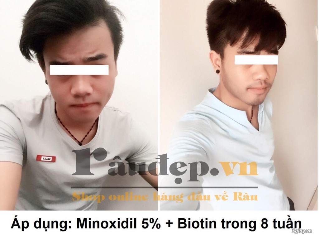 Thuốc Mọc Râu Quai Nón Minoxidil 5% của Mỹ >>|Chắc Chắn Mọc Râu| - 6