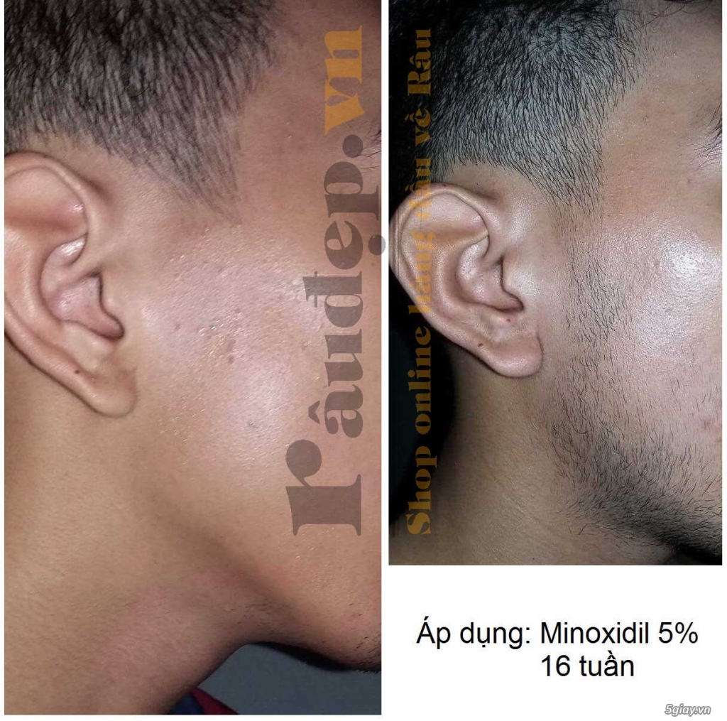 Thuốc Mọc Râu Quai Nón Minoxidil 5% của Mỹ >>|Chắc Chắn Mọc Râu| - 9