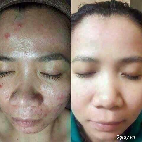 Chấm mụn khổ qua pizu - 8