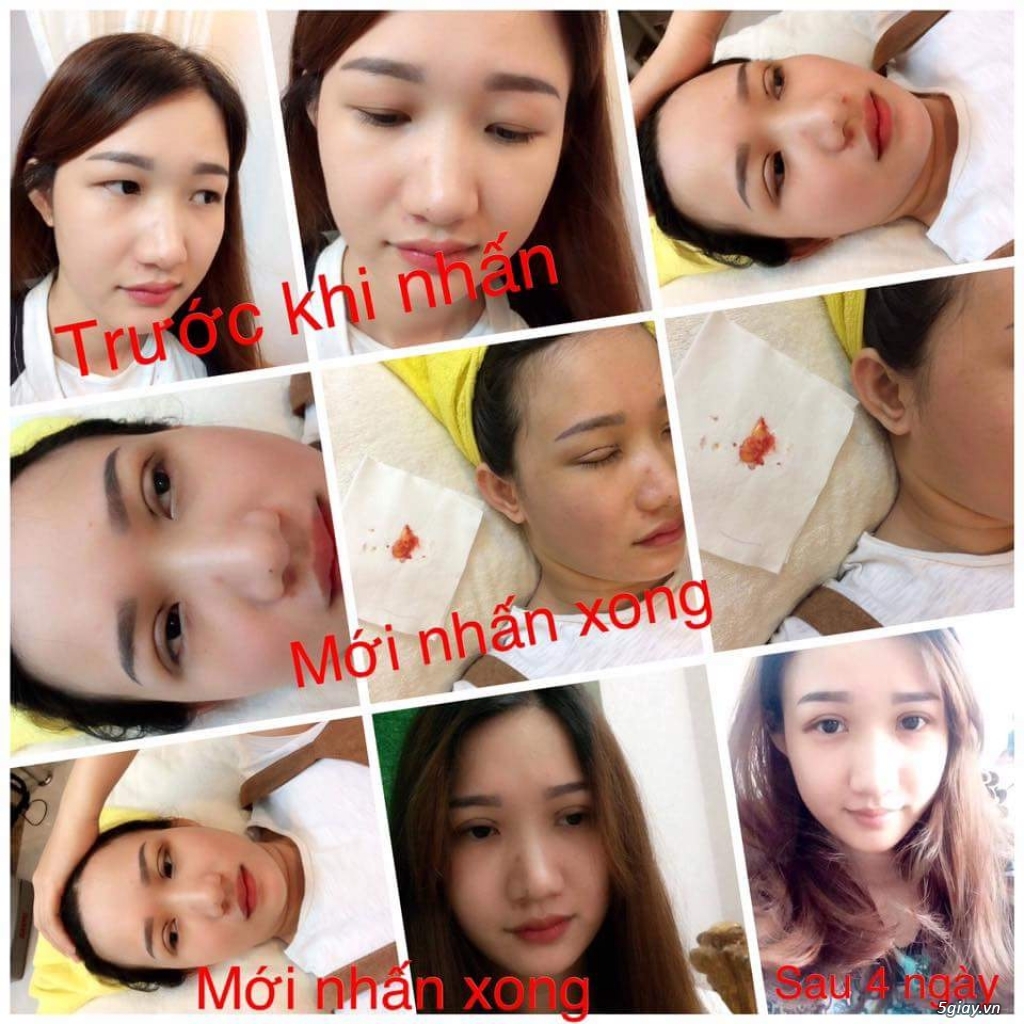 BẤM MÍ VĨNH VIỄN - CẮT MẮT HAI MÍ TO TRÒN - NÂNG MŨI XINH LUNG LINH - 1