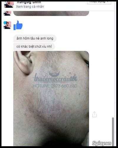 Thuốc mọc râu tốt Minoxidil 5% - 5