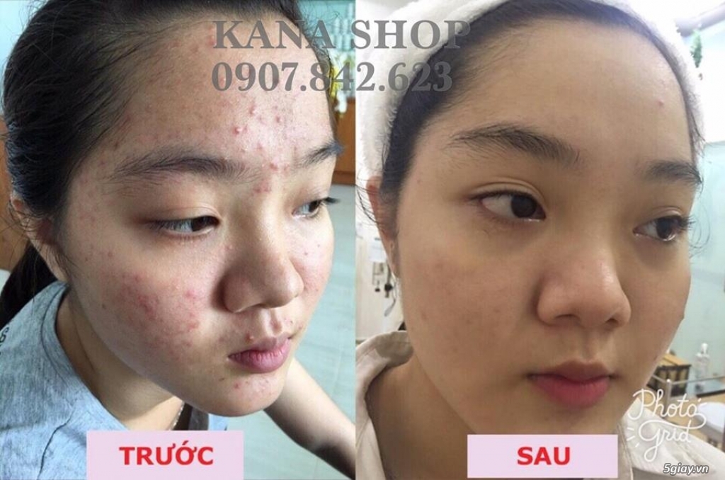 Bộ kem đặc trị mụn tái tạo da và làm trắng da của D.r Yanhee Thái Lan - 4