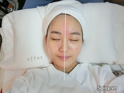 MÁY TIÊM DƯỠNG CHẤT MICRO POWER - 2