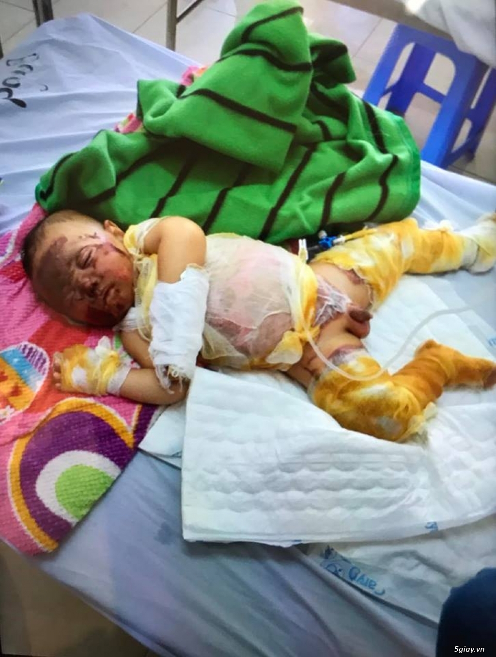 [Từ Thiện] Bé Bảo Khánh Bị Bỏng Toàn Thân