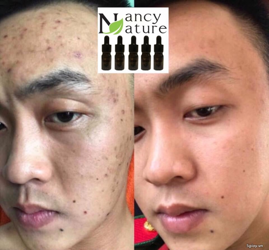 Serum trị mụn Nancy care an toàn với mọi loại da và hiệu quả cực nhanh - 1