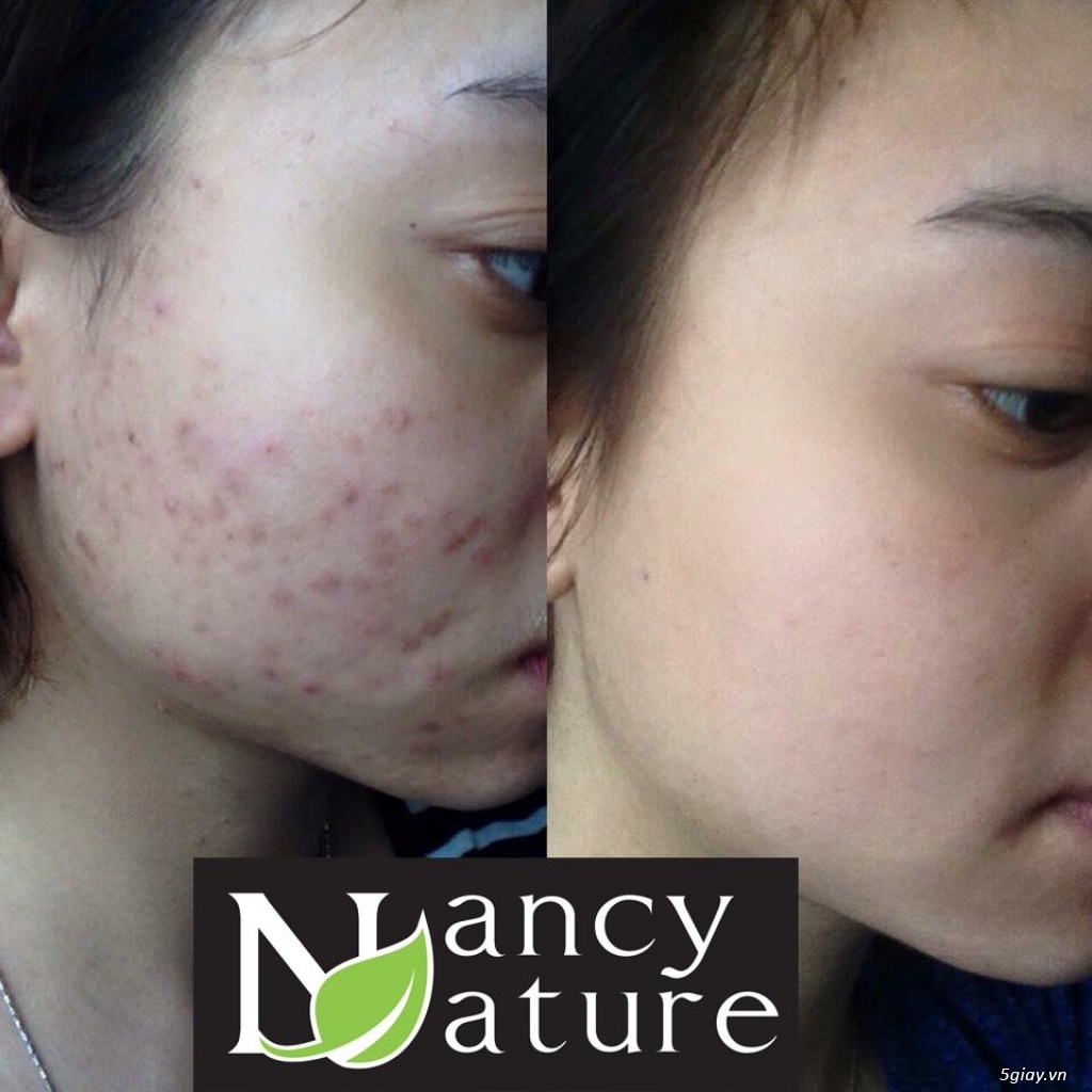 Serum trị mụn Nancy care an toàn với mọi loại da và hiệu quả cực nhanh - 2