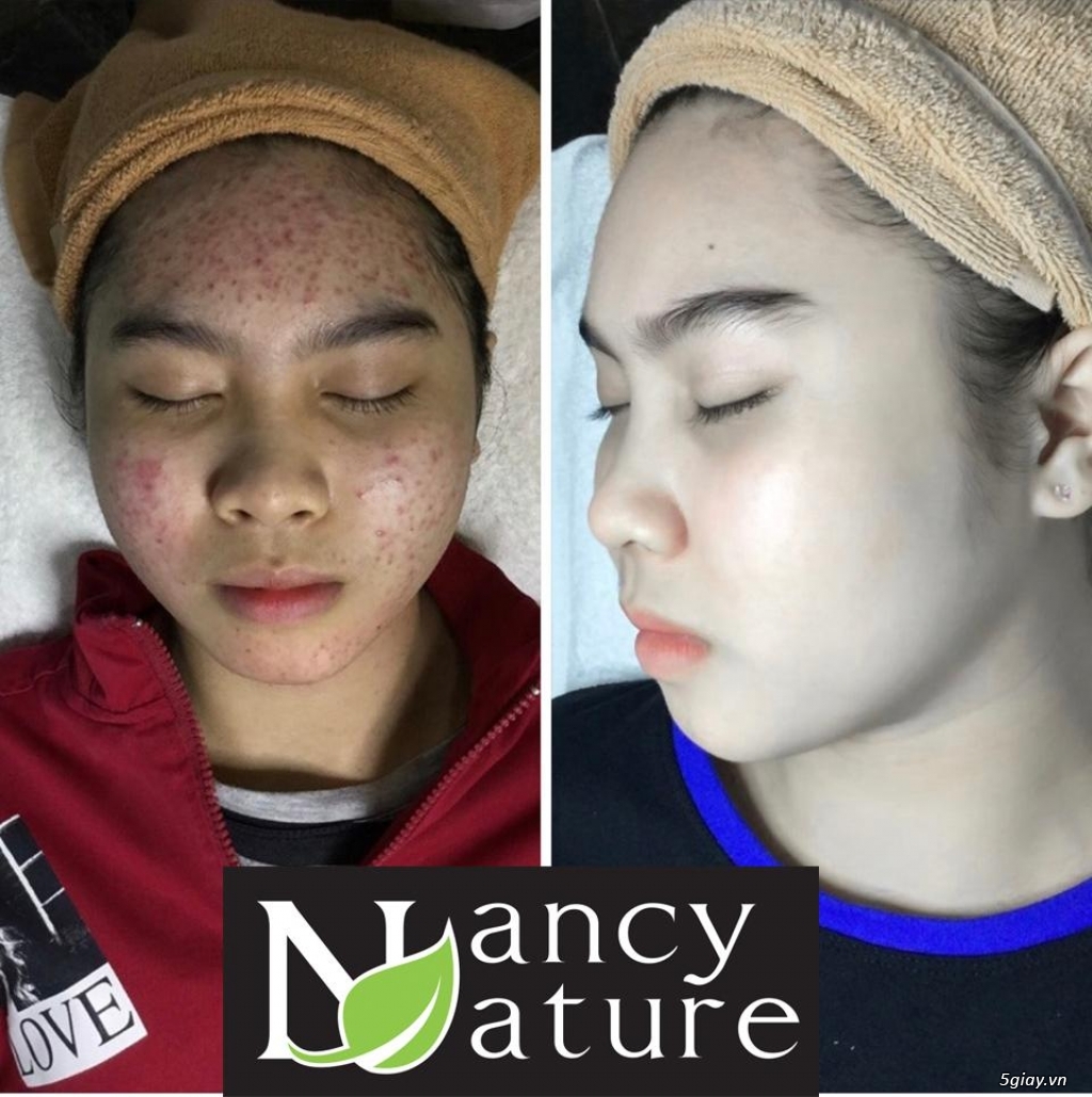 Serum trị mụn Nancy care an toàn với mọi loại da và hiệu quả cực nhanh - 4