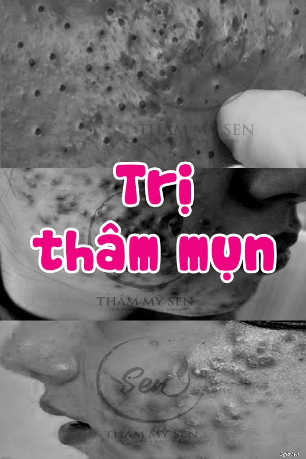 Nguyên nhân gây thâm mụn