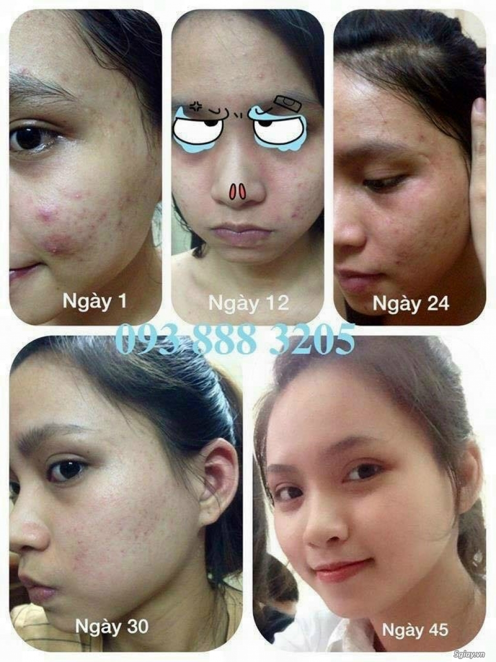 Trị mụn thâm nám an toàn, hiệu quả từ thuốc nam Song Duy - 10