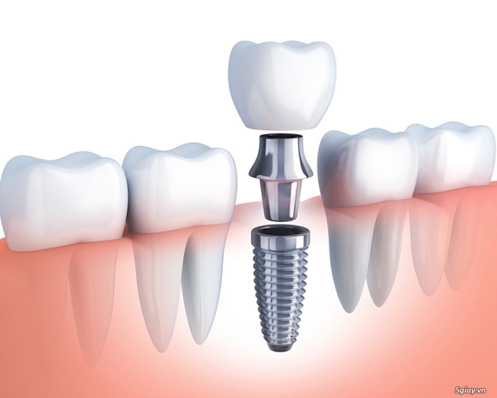 Trồng răng Implant phương pháp phục hình răng đã mất ăn nhai như rthật